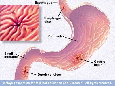 imagini ulcerul stomacului